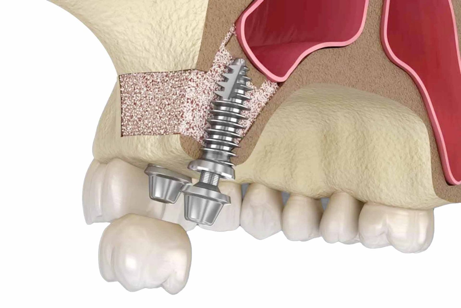 chicago dental implants and oral surgery