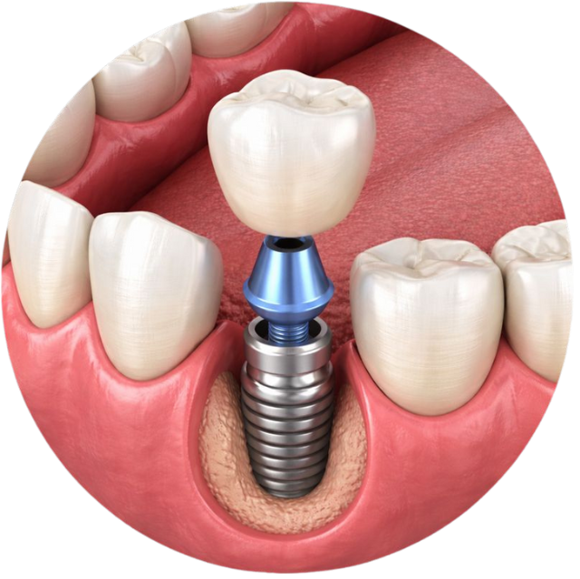 Single Implants -Trusted dental implants In chicago il
