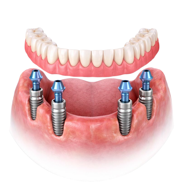 Implant Supported Dentures - Expert dental implants in chicago
