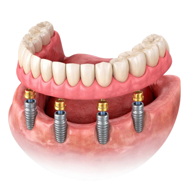 Full Mouth Dental Implants in chicago