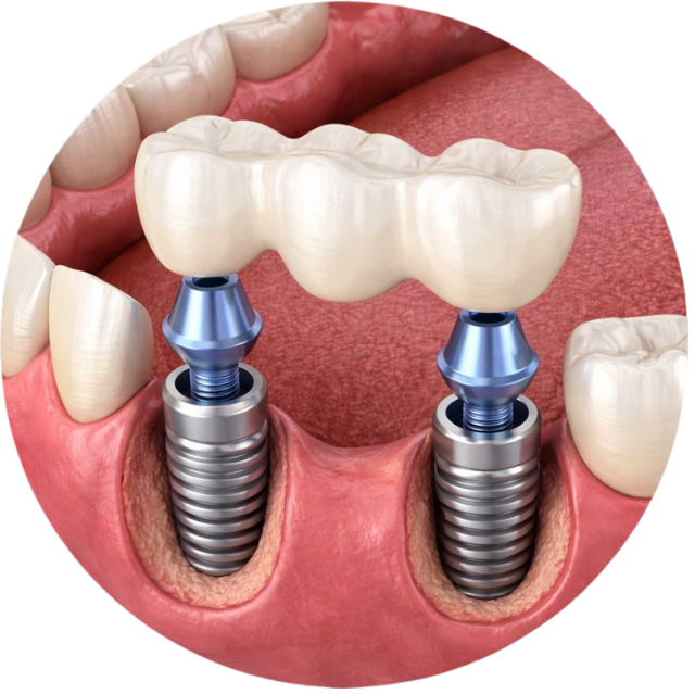 Bridge Implants - dental implants in chicago area