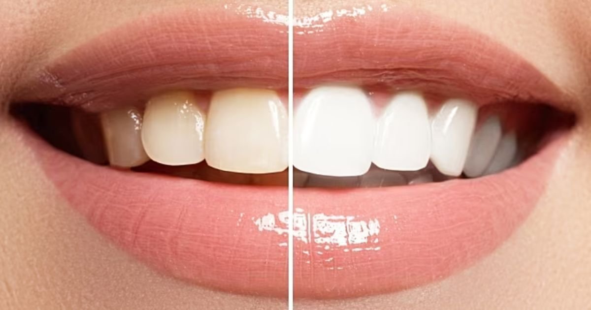 teeth whitening chicago
