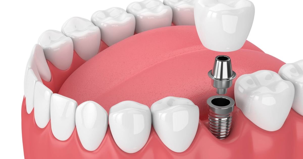 Affordable Dental Implants In Chicago
