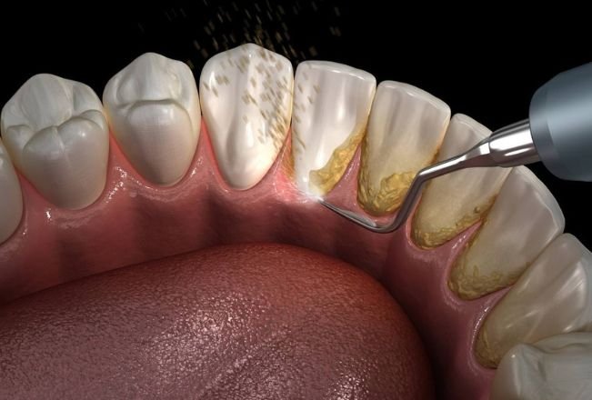 Dental Deep Cleaning Services In chicago