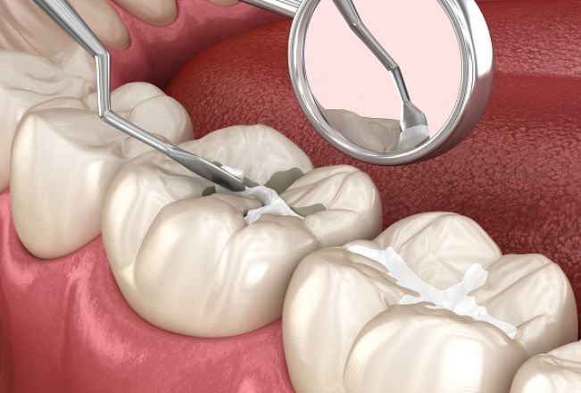 Dental Sealants In chicago