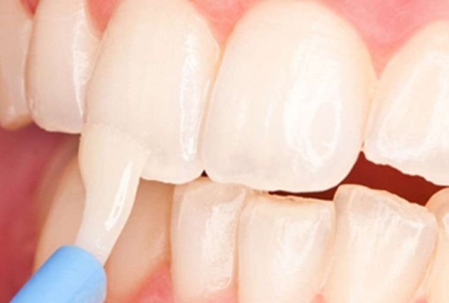 Fluoride Treatment In chicago