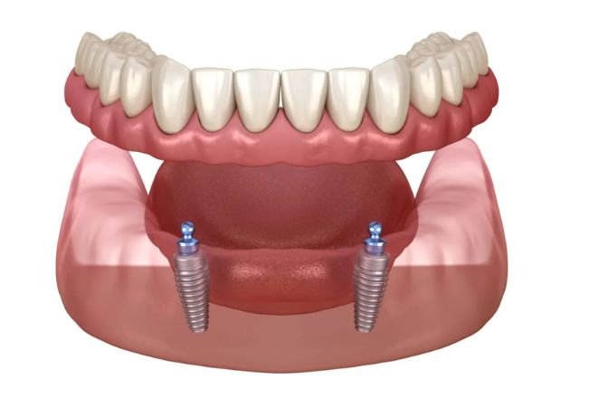 Implant-Supported Dentures