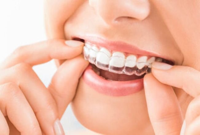 Invisalign Clear Aligners in chicago il