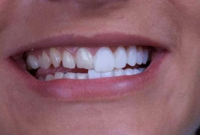 Porcelain Veneers in chicago il