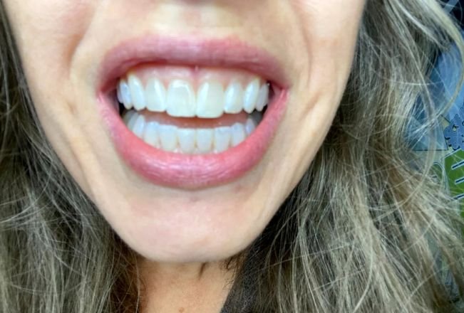 Whitening for Sensitive Teeth