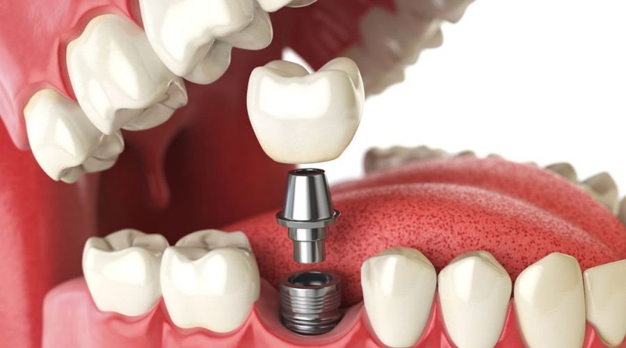 cost of dental implants chicago area